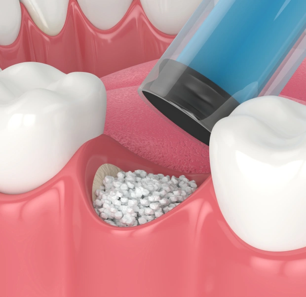 Bone grafting procedure to prepare the jaw for dental implants in Saginaw, MI