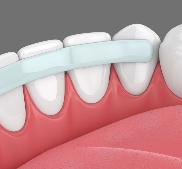 Dental bonding used to repair chipped and damaged front teeth
