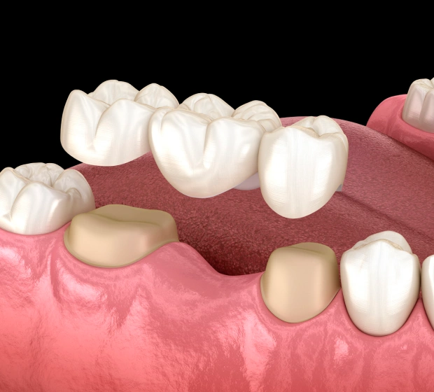 Dental bridge replacing missing teeth for a complete smile