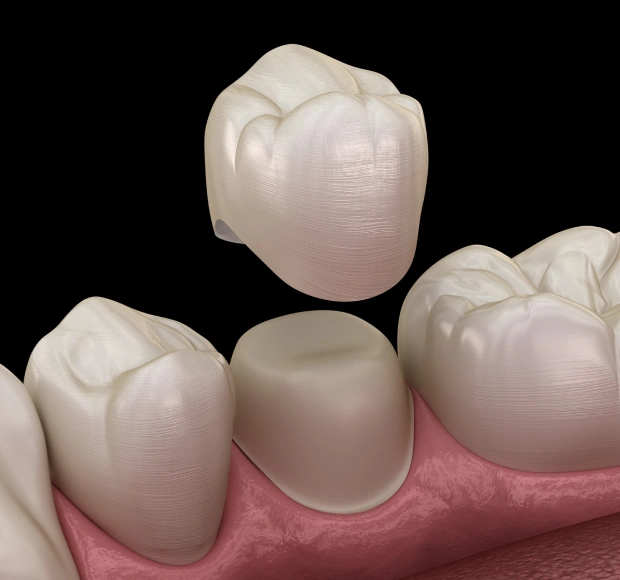 Custom dental crowns restoring damaged and weakened teeth
