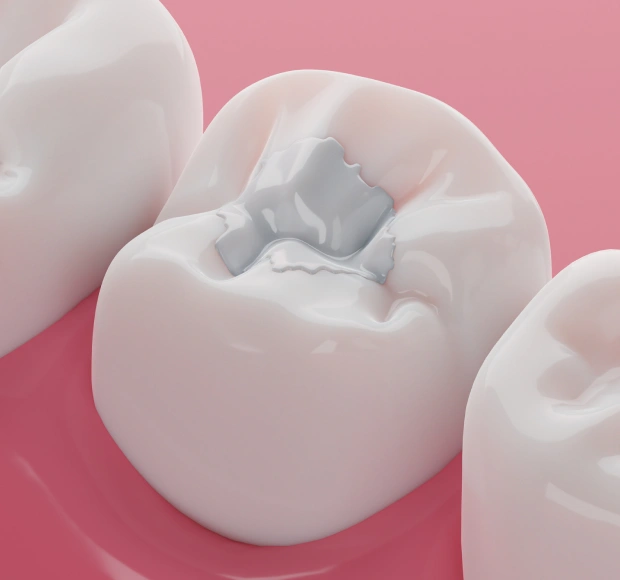 Tooth-colored dental filling restoring a cavity with a natural appearance
