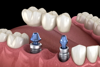 Implant-supported dental bridge replacing multiple missing teeth