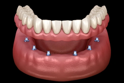 Full arch implant-supported dentures restoring function and confidence