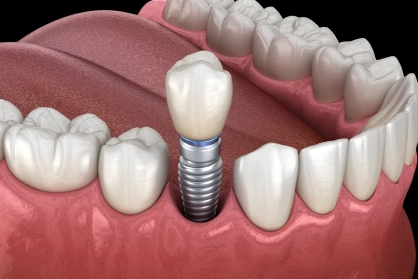 Single dental implant restoring a missing tooth with a natural appearance