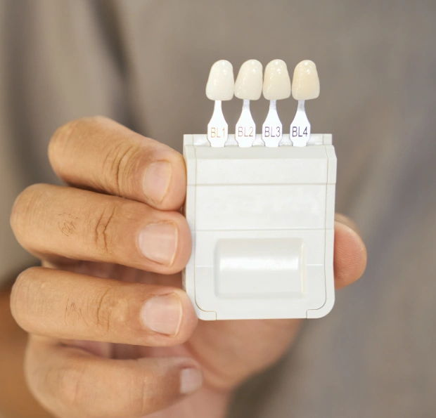 Dental veneer material options for creating a natural-looking smile